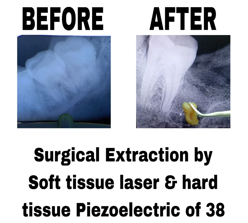 before-and-after-image-of-surgical-extraction-by-soft-tissue-laser-and-hard-tissue-piezoelectric-of-38-at-dentity-dental-rajarhat-teghoria-newtown