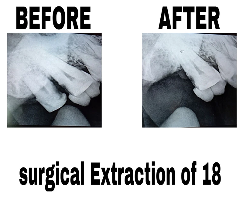 before-and-after-image-of-surgical-extraction-of-18-at-dentity-dental-dum-dum-cantonment