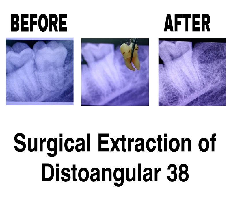 before-and-after-image-of-surgical-extraction-of-distoangular-38-at-dentity-dental-tollygunge-netaji-nagar
