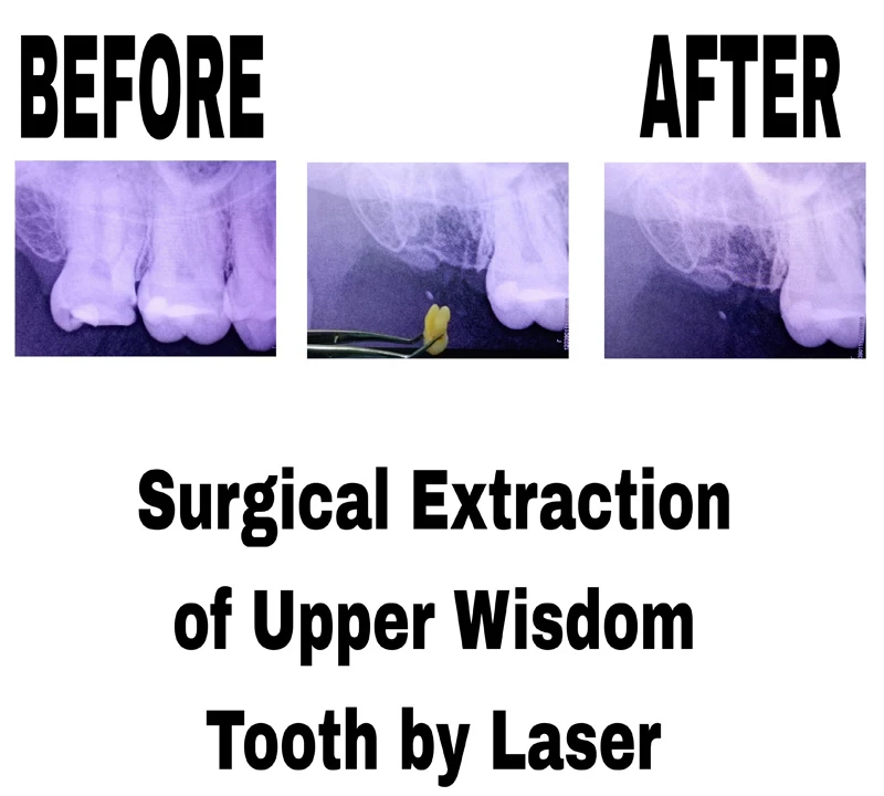 before-and-after-image-of-surgical-extraction-of-upper-wisdom-tooth-by-laser-at-dentity-dental-beleghata