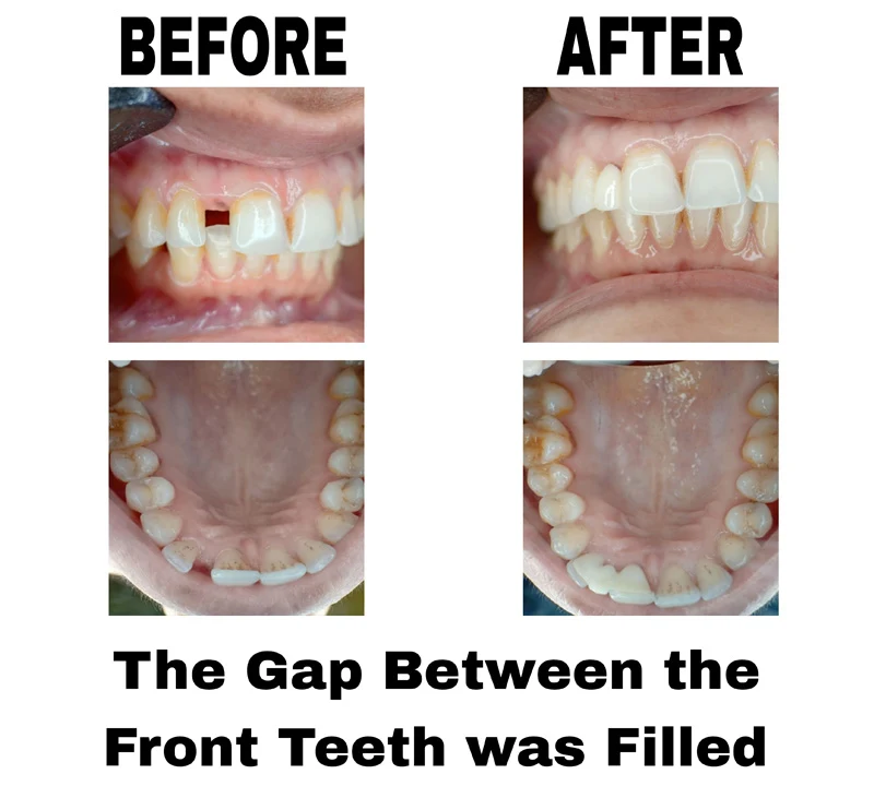 before-and-after-image-of-the-gap-between-the-front-teeth-was-filled-using-a-maryland-bridge-treatment-at-dentity-dental-rajarhat-teghoria-newtown