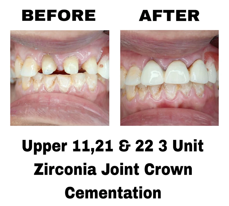 before-and-after-image-of-upper-11-12-and-22-3-unit-zirconia-joint-crown-cementation-at-dentity-dental-tollygunge-suryanagar