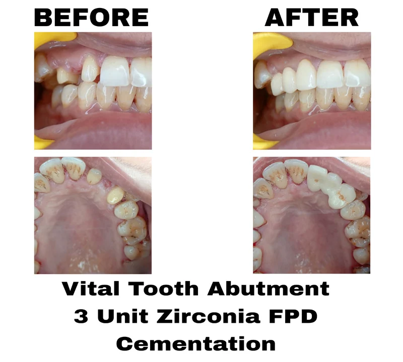 before-and-after-image-of-vital-tooth-abutment-3-unit-zirconia-fpd-cementation-treatment-at-dentity-dental-teghoria