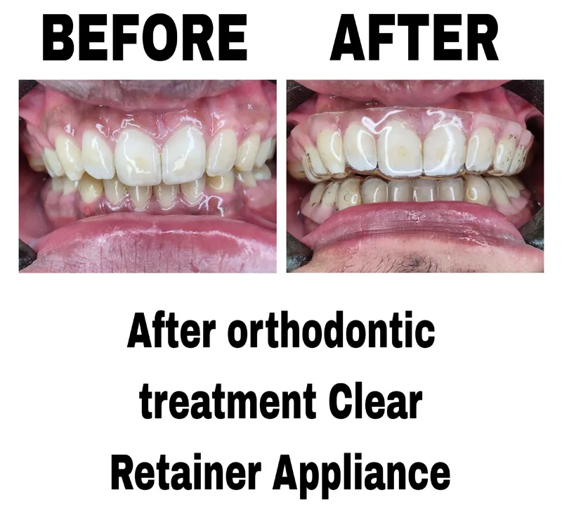 before-and-after-treatment-of-after-orthodontic-treatment-clear-retainer-appliance-at-dentity-dental-sonarpur