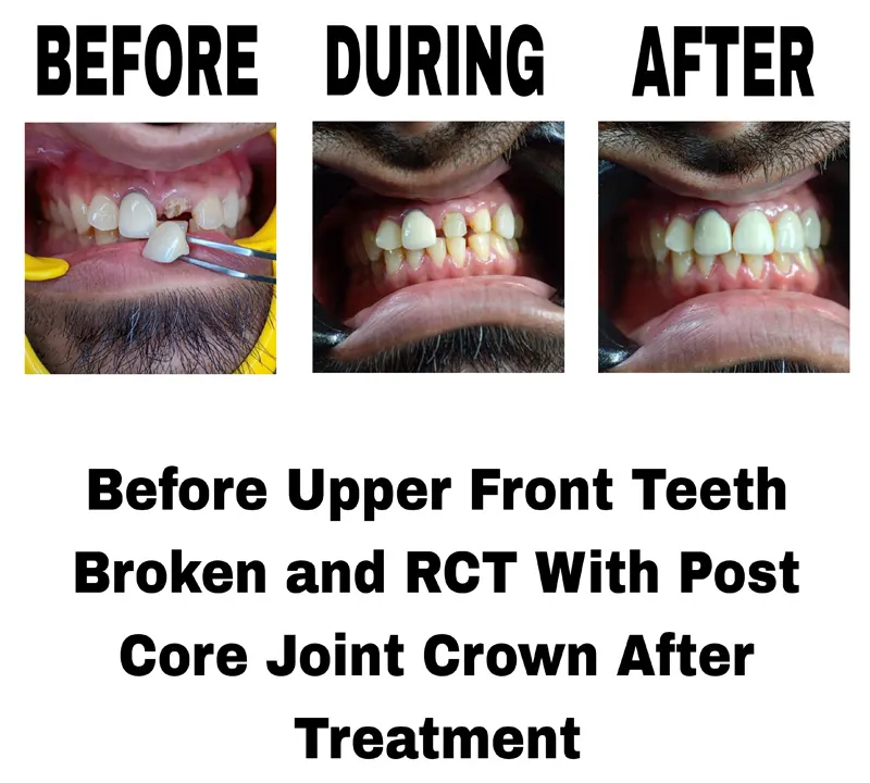 before-during-and-after-image-of-upper-front-tooth-broken-and-rct-with-post-core-joint-crown-after-treatment-at-dentity-dental-beleghata
