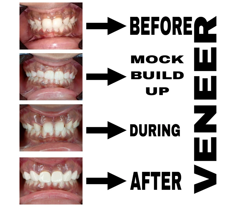 before-during-and-after-image-of-veneering-treatment-at-dentity-dental-rajarhat-teghoria-newtown